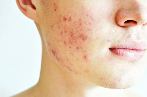 treating Common Skin Diseases