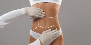 Abdominal Liposuction