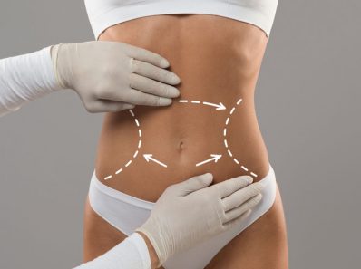 Abdominal Liposuction