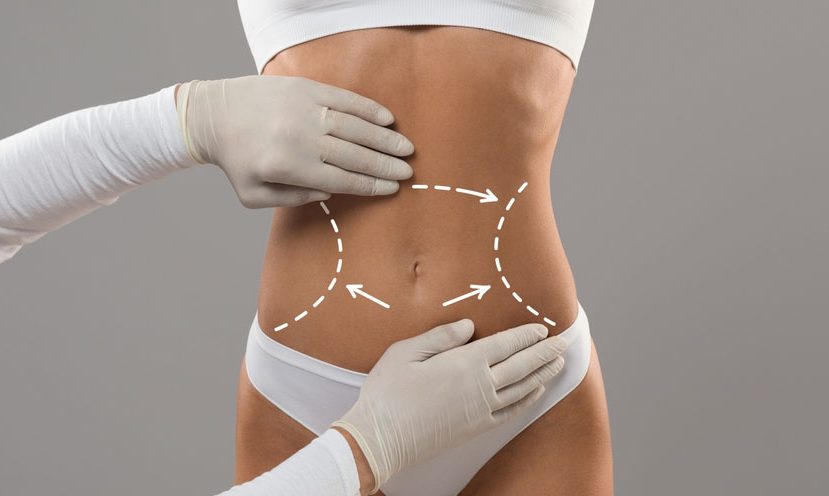 Abdominal Liposuction