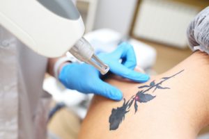 Tattoo Removal Aftercare